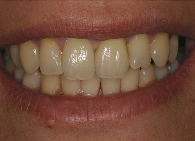 1-Veneer-nachher.jpg