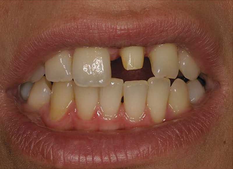 1-Veneer-vorher.jpg